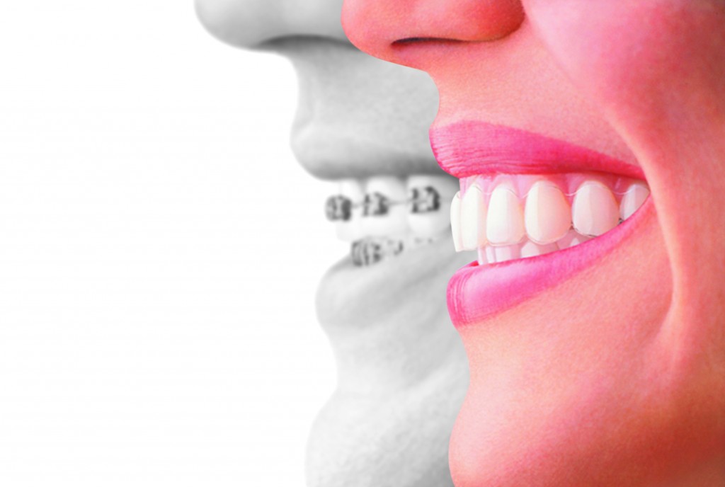 invisalign braces